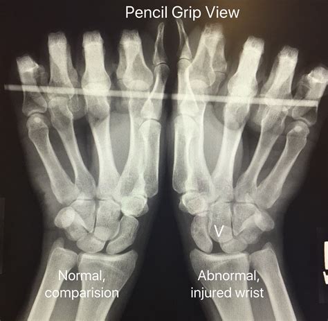 scapholunate ligament injury physical exam